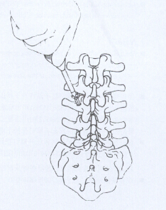 美敦力TENOR脊柱内固定系统手术操作方法