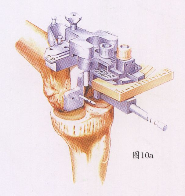 Biomet AGC 全膝关节系统-后交叉韧带保留型和替代型（Cam&Groove）手术技术