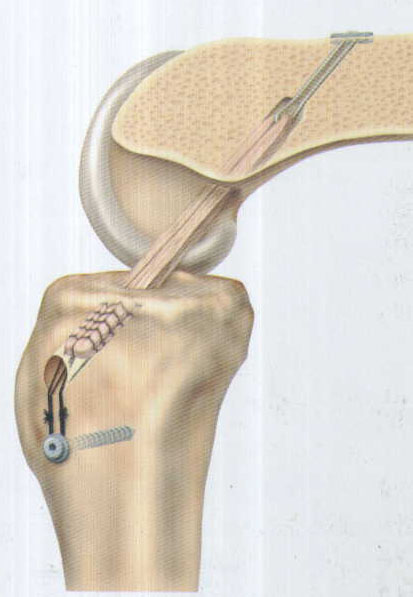 施乐辉 膝关节前交叉韧带重建技术