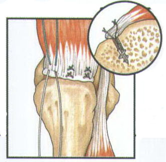 强生DePuy Mitek FASTIN RC锚钉