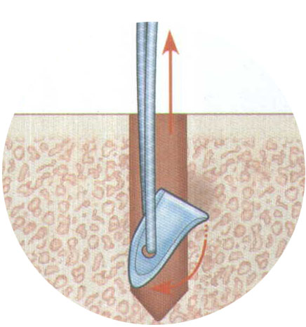 强生DePuy Mitek MICROFIX可吸收的快速锚钉