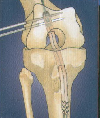 强生DePuy Mitek RIGIDfix交叉韧带重建可吸收横穿钉股骨端固定系统 