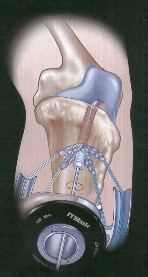 DePuy Mitek Intrafix ACL胫骨固定钉