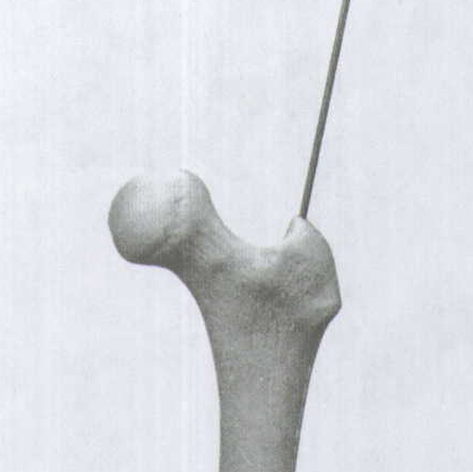 ITST粗隆间／粗隆下骨折髓内钉固定系统手术技术