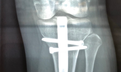 DePuy ACE 钛合金动态胫骨髓内钉系统