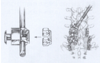 美敦力椎弓根螺钉固定手术操作方法