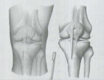 BIOFIX（百优）自身增强可吸收ACL界面螺钉ACL Interference Screw